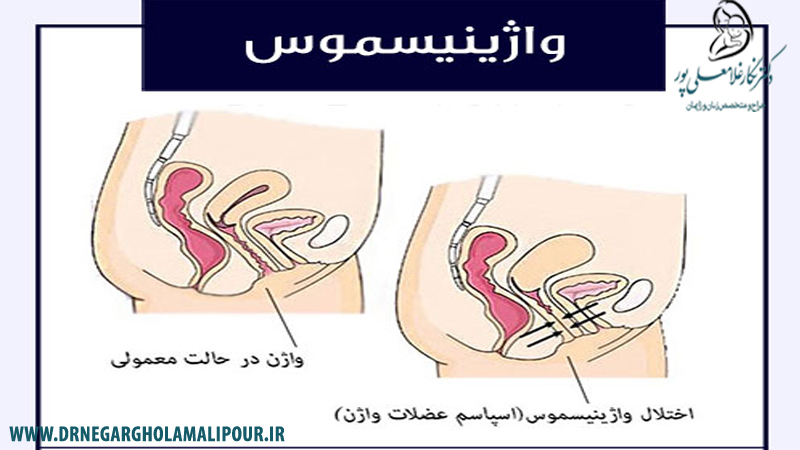 درمان واژینیسموس در رشت