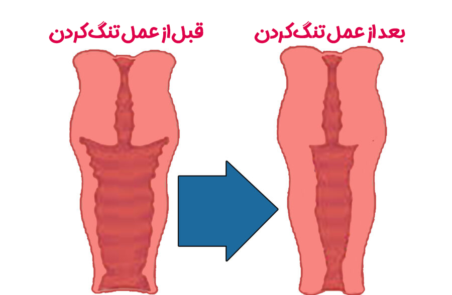 از کجا بفهمیم واژن تنگی داریم