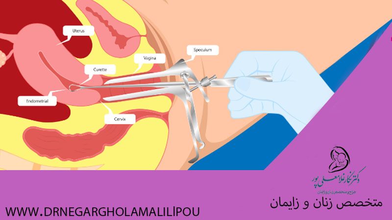 کورتاژ برای سقط جنین