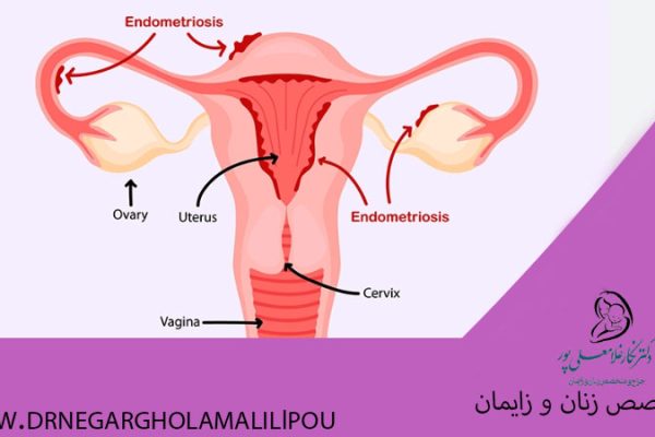 بارداری با آندومتریوز ممکن است