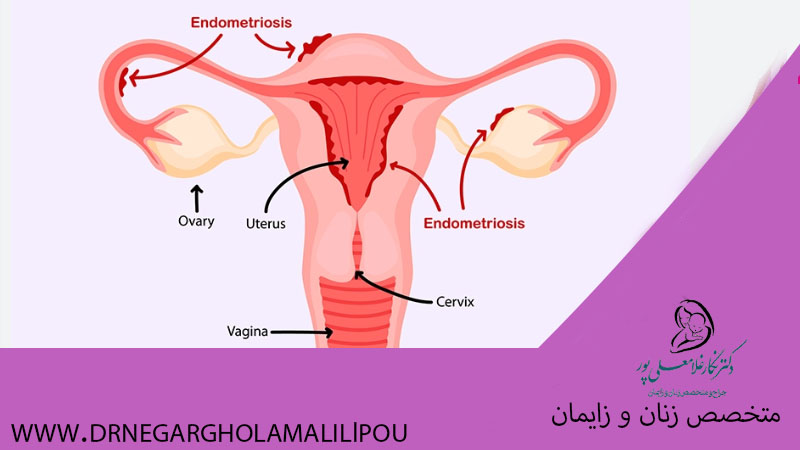 بارداری با آندومتریوز ممکن است