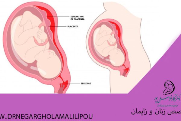 هماتوم بارداری