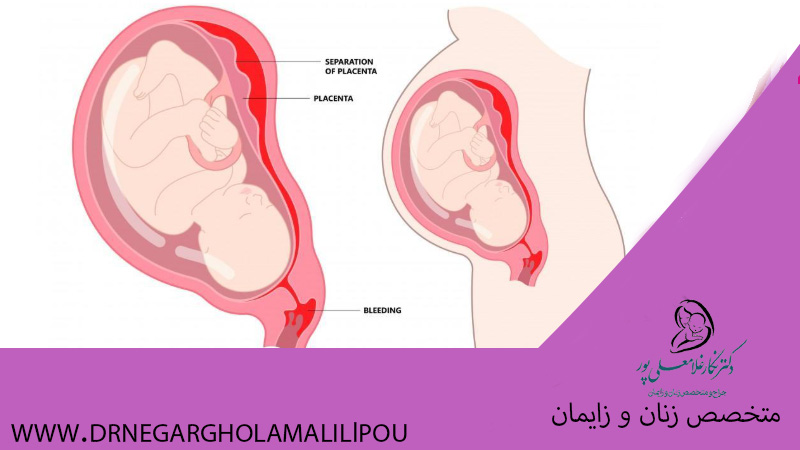 هماتوم بارداری